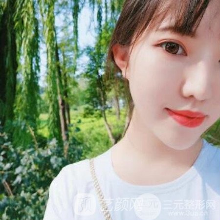 四川省人民醫(yī)院傅榮開內(nèi)眼角+割雙眼皮三個月果分享~